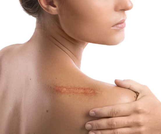 KELOID INJECTION by Bali Beauty Center